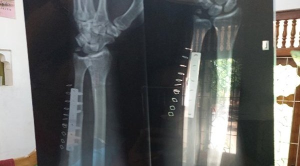 Röntgenbild zeigt Knochenbrüche 